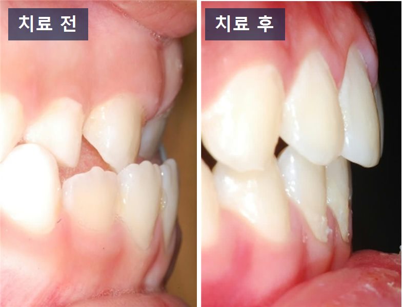 교정 케이스 · 앞니가 반대로 물릴 때, 정말 기다려도 될까요? 치료 전후 사진