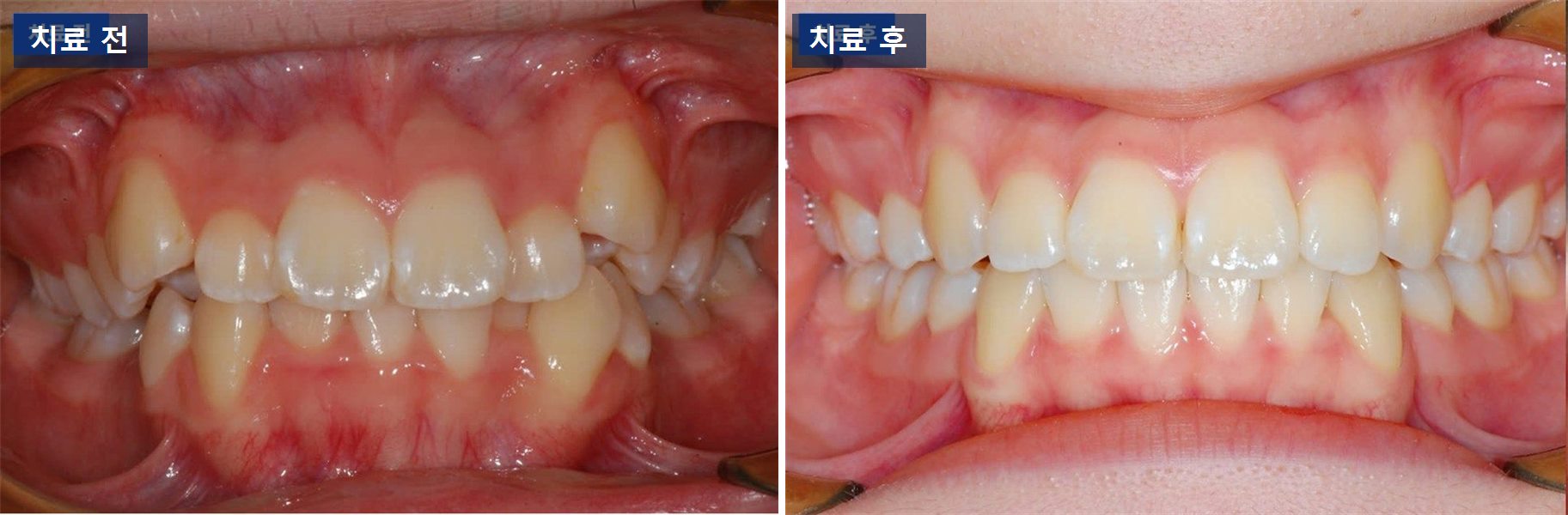 교정 케이스 · 클리피씨 교정으로 겹쳐 난 치열을 어떻게 폈을까 치료 전후 사진