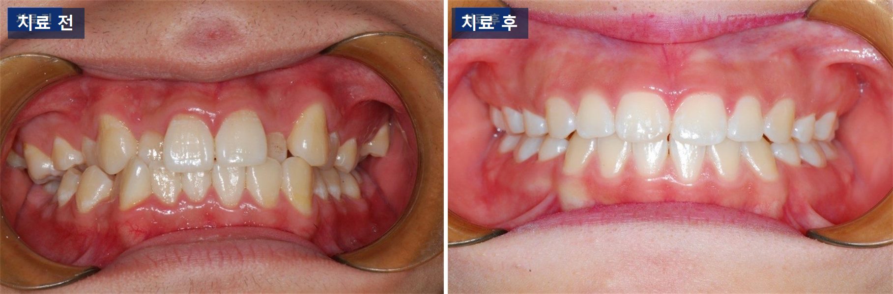 교정 케이스 · 무턱 교정, 수술 없이 어디까지 갈 수 있을까 치료 전후 사진