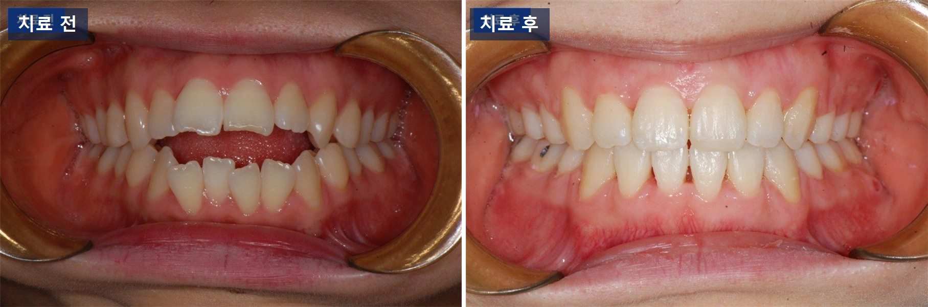 교정 케이스 · 개방교합, 앞니가 안 닿는 이유는 혀에 있었습니다 치료 전후 사진