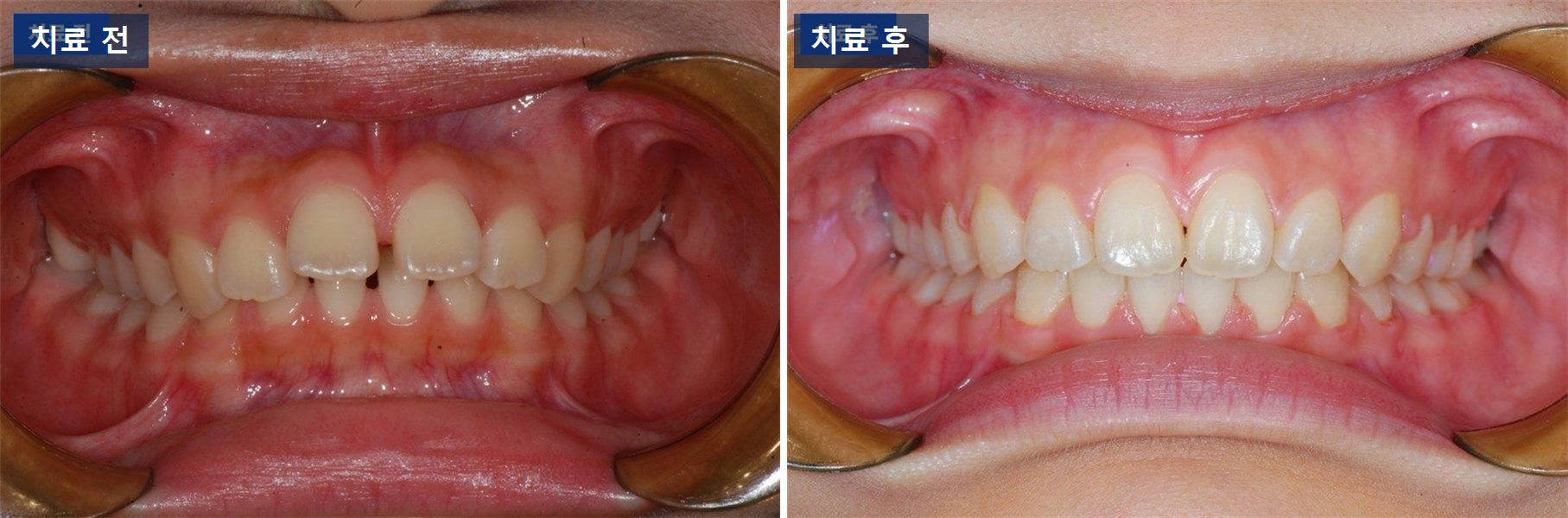 교정 케이스 · 앞니 벌어짐, 원인이 깊은 물림이었던 경우 치료 전후 사진