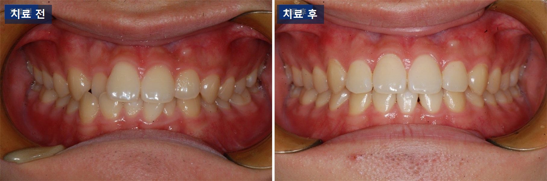 교정 케이스 · 치아교정 기간, 1년 안에 끝난 아래 앞니 케이스 치료 전후 사진