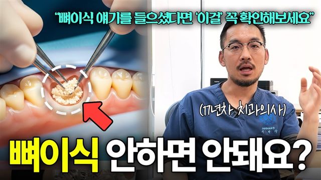 이바다이야기 영상: 임플란트 뼈이식, 치과마다 말이 다른 이유
