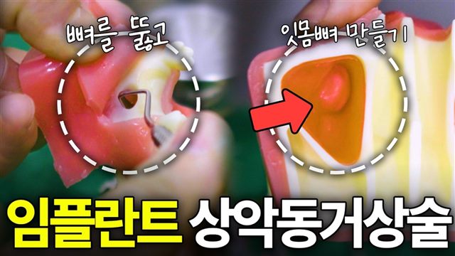이바다이야기 영상: 상악동 거상술 과정 직접 보여 드립니다